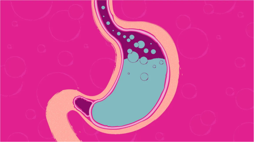 Acid reflux and PPI’s