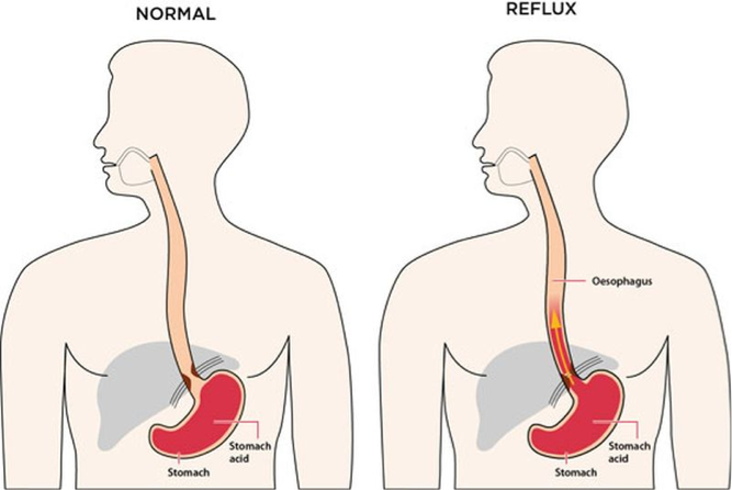 Acid reflux and nutrition
